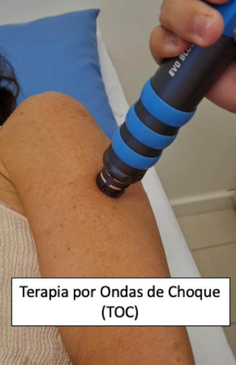 Terapia Por Ondas De Choque Toc O Que Indica Es E Benef Cios