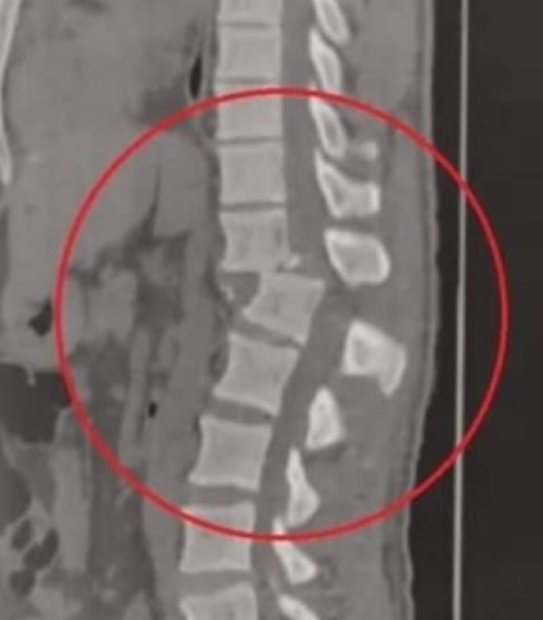 Fratura da Coluna Vertebral: Causas, Sintomas, Exames e 2 Tratamentos ...