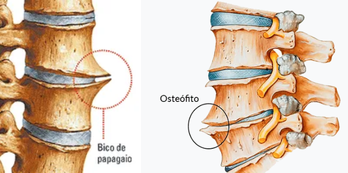 Bico de Papagaio (Osteófito): 6 Causas, Sintomas e Tratamentos Naturais ...