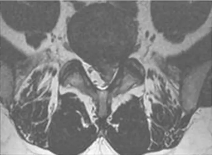 Corte axial de ressonância mostrando hérnia L5–S1 e sua relação com o saco dural.