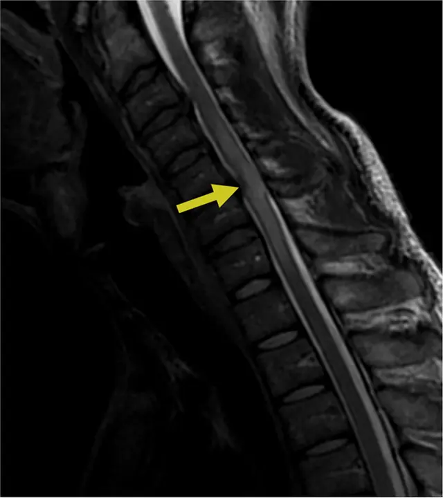 Ressonância cervical em T2 no corte sagital, com seta amarela indicando compressão da medula em C5–C6 por alterações do disco e osteófitos.