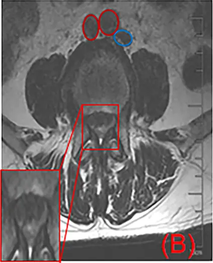 Ressonância magnética em T2 no corte axial de L4–L5, com estreitamento do canal vertebral destacado por um retângulo vermelho.