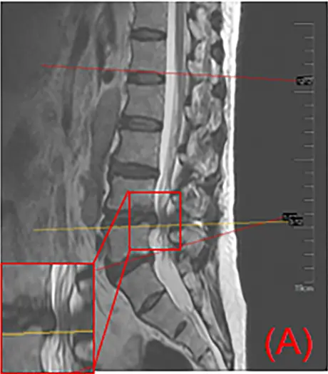 Ressonância magnética em T2 no corte sagital, com hérnia L4–L5 e estreitamento do canal destacados por um retângulo vermelho.
