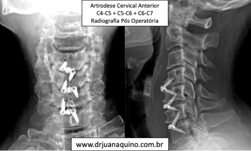 Radiografia pos operatorio de artrodese cervical anterior 3 niveis