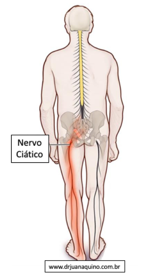 Ilustracao do Nervo Ciático - Dr Juan Aquino - www.drjuanaquino.com.br