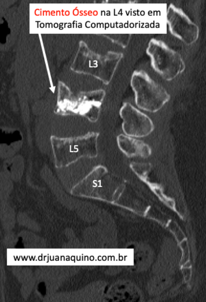 imagem de tomografica computadorizada mostrando vertebroplastia lombar para tratar fratura