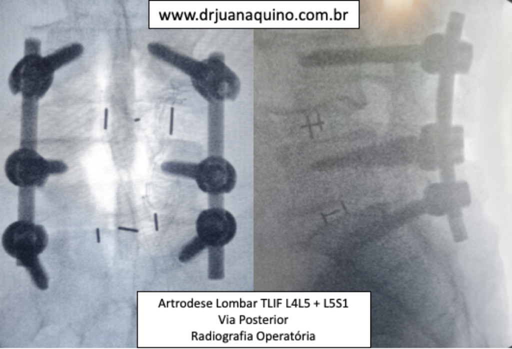 Artrodese Lombar 2 niveis L4 sobre L5 e L5 sobre S1. Imagem da Radiografia Intraoperatória. Dr Juan Aquino - www.drjuanaquino.com.br