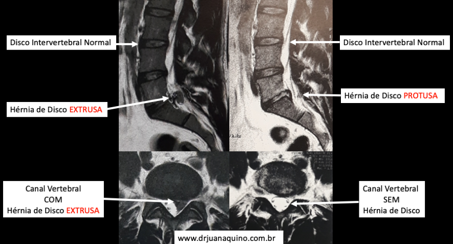 Exame de Ressonância Magnética de Coluna Lombar com Reconstrução de Imagens em Sagital T2 e Axial T2