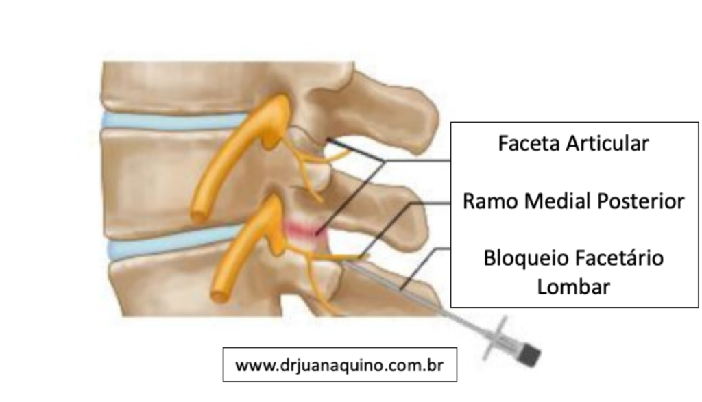 Bloqueio Facetário Lombar - Dr Juan Aquino - www.drjuanaquino.com.br