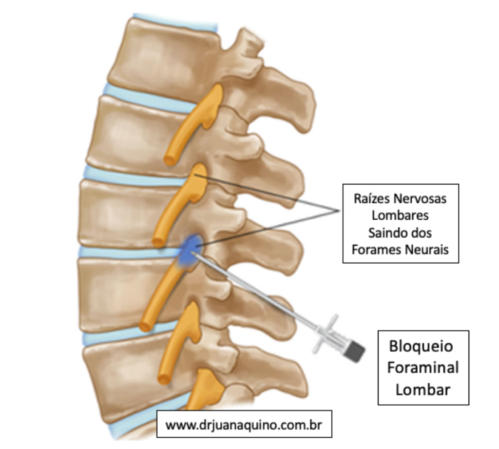 Bloqueio Foraminal Lombar - Dr Juan Aquino - www.drjuanaquino.com.br