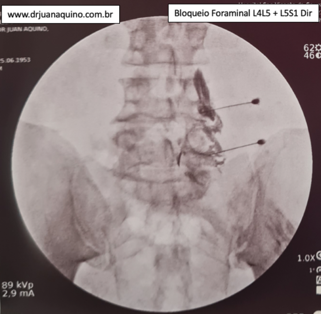 Bloqueio Foraminal para Alívio de Radiculopatia Compressiva por Hérnias de Disco L4L5 + L5S1 à Direita. Imagem da Radioscopia (Radiografia Intraoperatória). Dr Juan Aquino - www.drjuanaquino.com.br