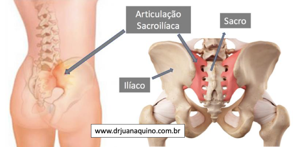 Ilustração da Articulação Sacroilíaca que une a Bacia no Sacro, aonde é realizado o Bloqueio da Sacroilíaca ou Infiltração da Sacroilíaca. Dr Juan Aquino. -www.drjuanaquino.com.br