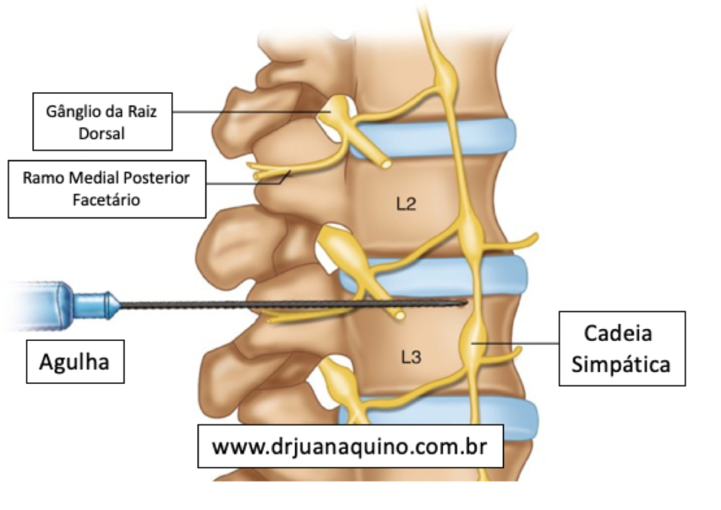 Ilustração do Bloqueio no Nervo Simpático. Dr Juan Aquino - www.drjuanaquino.com.br