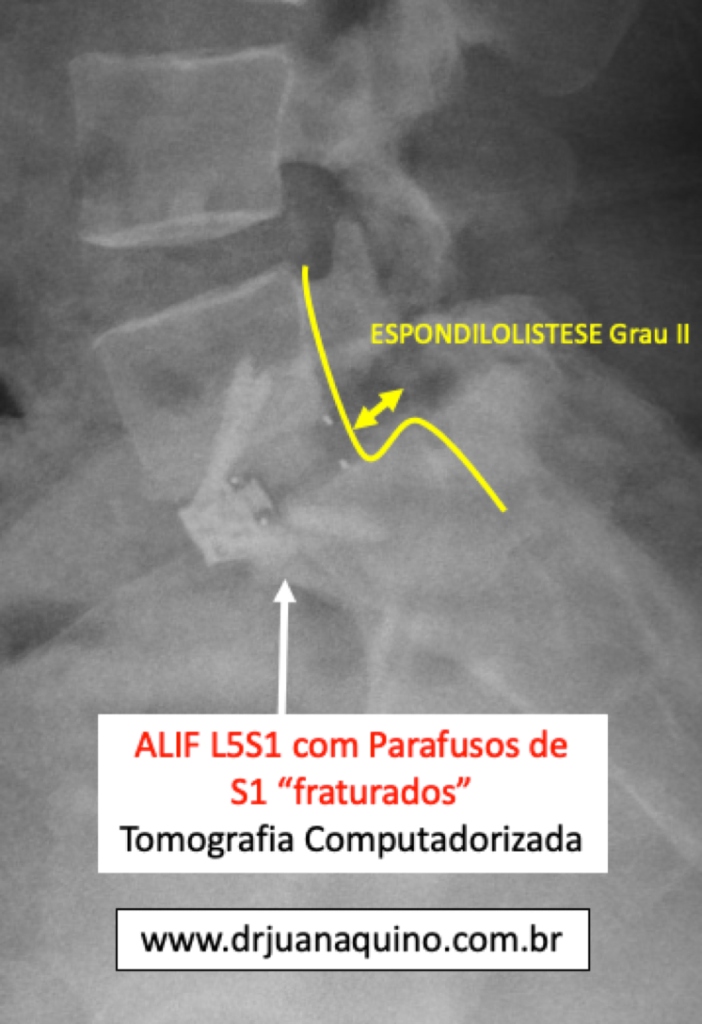 Espondilolistese ALIF L5S1 para Revisao Dr Juan Aquino