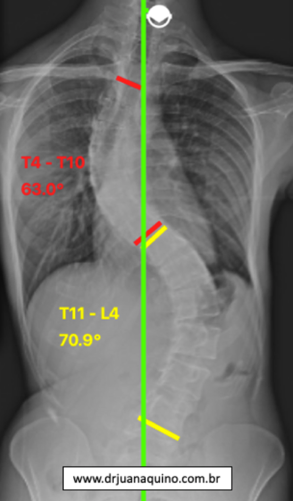 Radiografia Panorâmica evidenciando Escoliose Idiopática Dupla Curva sendo a Curva Toracolombar a Maior. Dr Juan Aquino - www.drjuanaquino.com.br