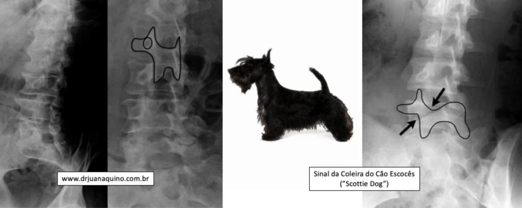 Sinal da Coleira do Cão Escocês. Dr Juan Aquino - www.drjuanaquino.com.br