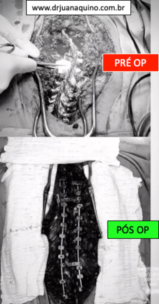 imagem comparativa de pre e pos operatorio de escoliose realizada pelo dr juan aquino