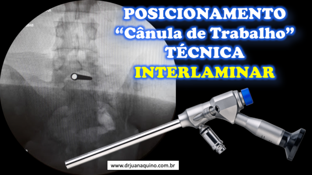 Posicionamento da canula de trabalho na Coluna Lombar - Dr Juan Aquino. www.drjuanaquino.com.br