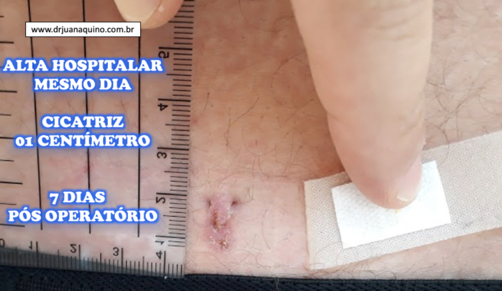 Cicatriz de 1 centimetro na Coluna Lombar - Dr Juan Aquino. www.drjuanaquino.com.br