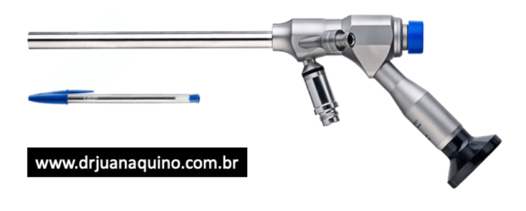 Imagem comparativa entre tamanho do Endoscópio e uma Caneta Bic. Dr Juan Aquino. www.drjuanaquino.com