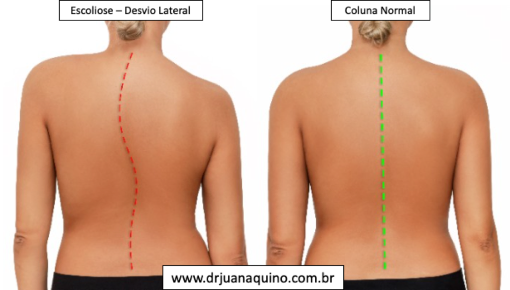 imagem com escoliose e com coluna normal