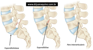 Imagem ilustrativa da Diferenca entre Espondilolistese e Espondilólise.