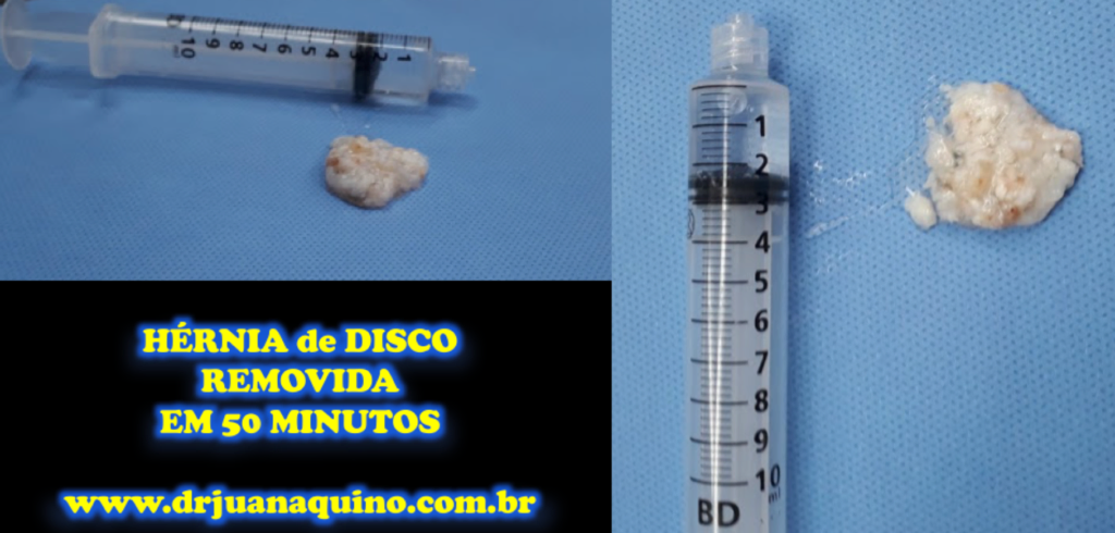 Hérnia de Disco Lombar removida em 50 minutos. Dr Juan Aquino wwwdrjuanaquino.com.br