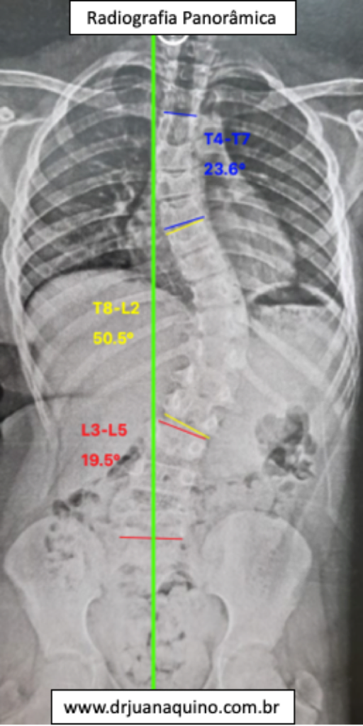 imagem com radiografia panoramica da coluna