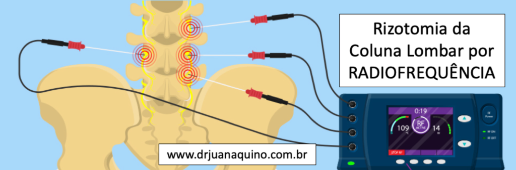 Ilustracao da radiofrquencia na coluna lombar. Dr Juan Aquino - www.drjuanaquino.com.br