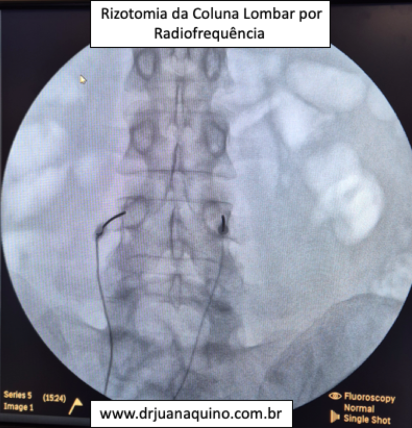 Imagem de Radioscopia (Fluoroscopia) de Rizotomia da Lombar feita por Radiofrequência para Tratamento de Dor na Coluna Crônica por Artrose da Coluna. Dr Juan Aquino - www.drjuanaquino.com.br