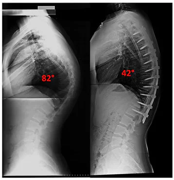 Cirurgia de Cifose