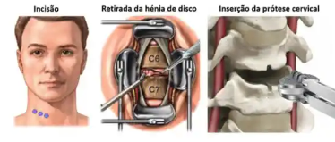 ilustracao da tecnica de artroplastia cervical anterior