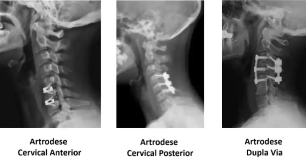 Artrodese Cervical