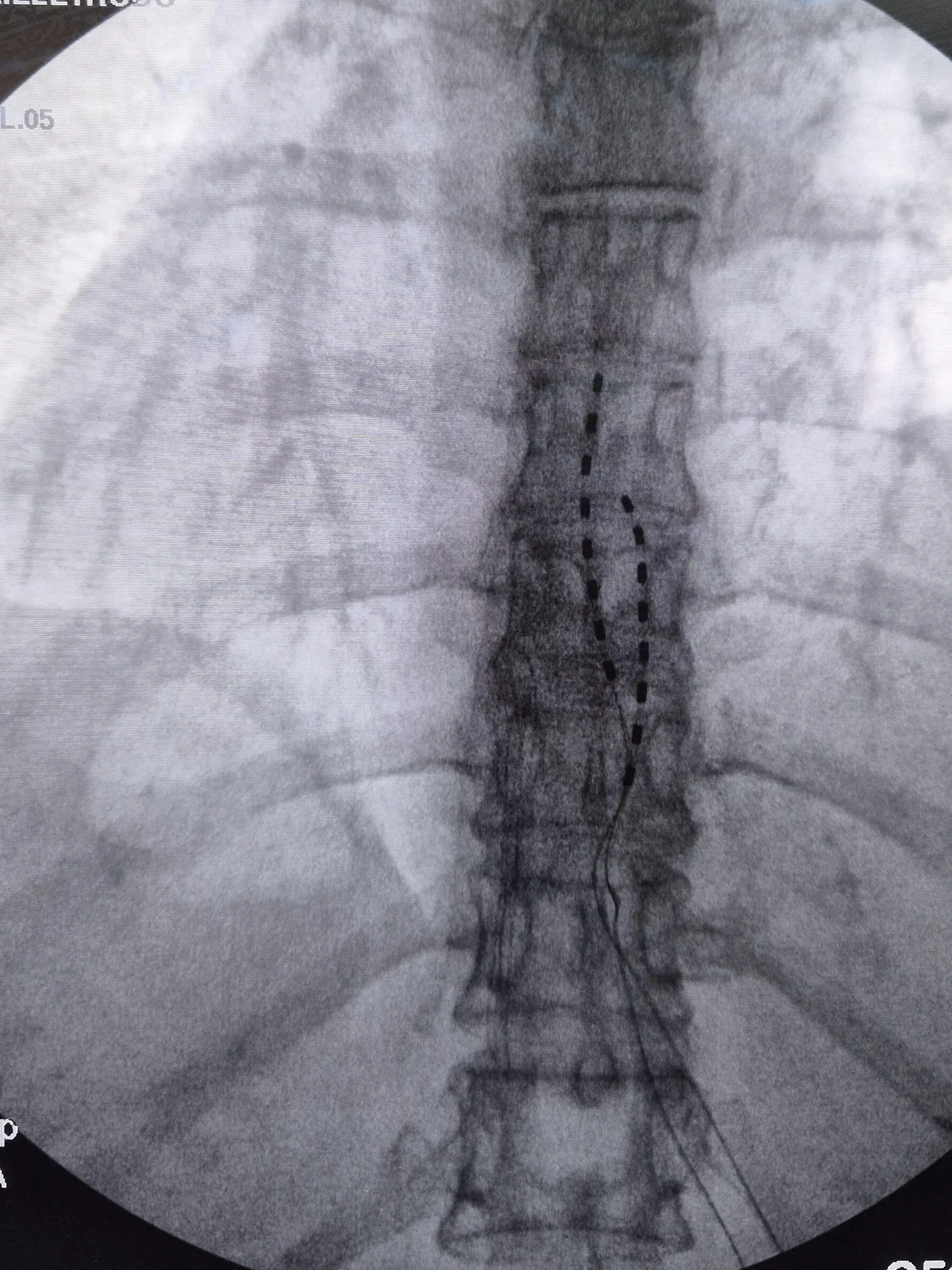 Neuroestimulador Medular