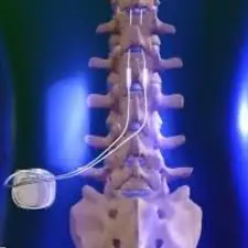 Neuroestimulação para Dor Pélvica Crônica na Endometriose: Tratamento Inovador e Eficaz