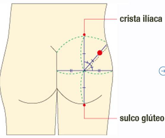 local de injecao intramuscular no glúteo
