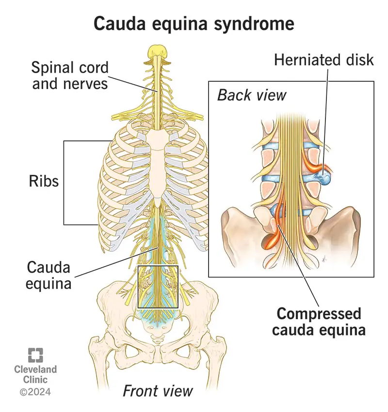sindrome da cauda equina