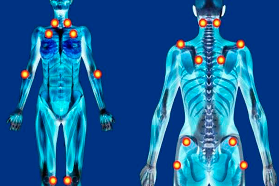 fibromialgia