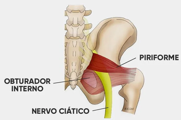 síndrome do piriforme