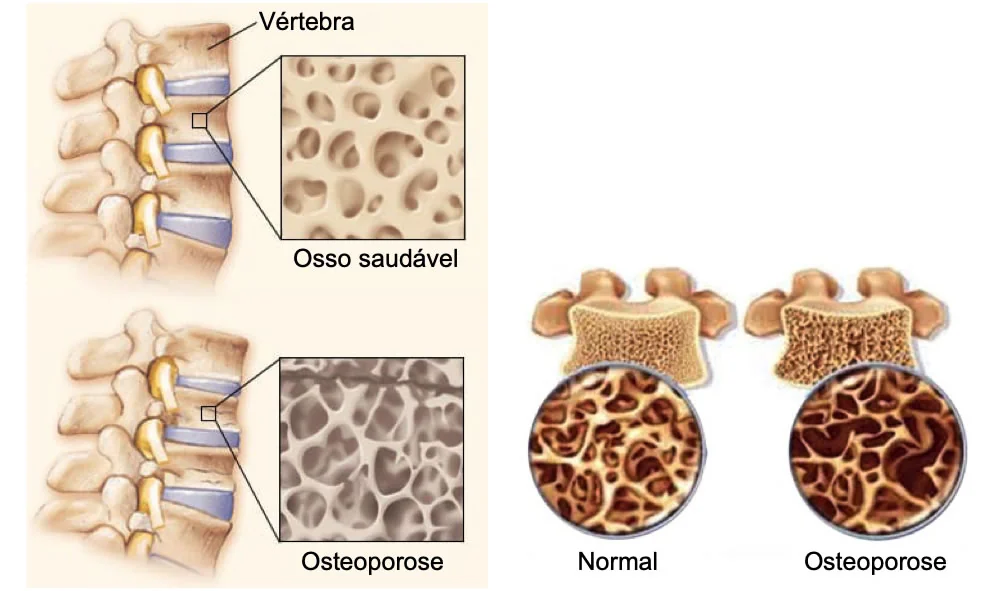 osteoporose e osteopenia