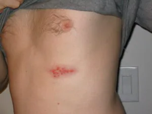 Fotografia clínica de lesões de herpes-zóster no tórax, com agrupamentos de pequenas bolhas e vermelhidão.