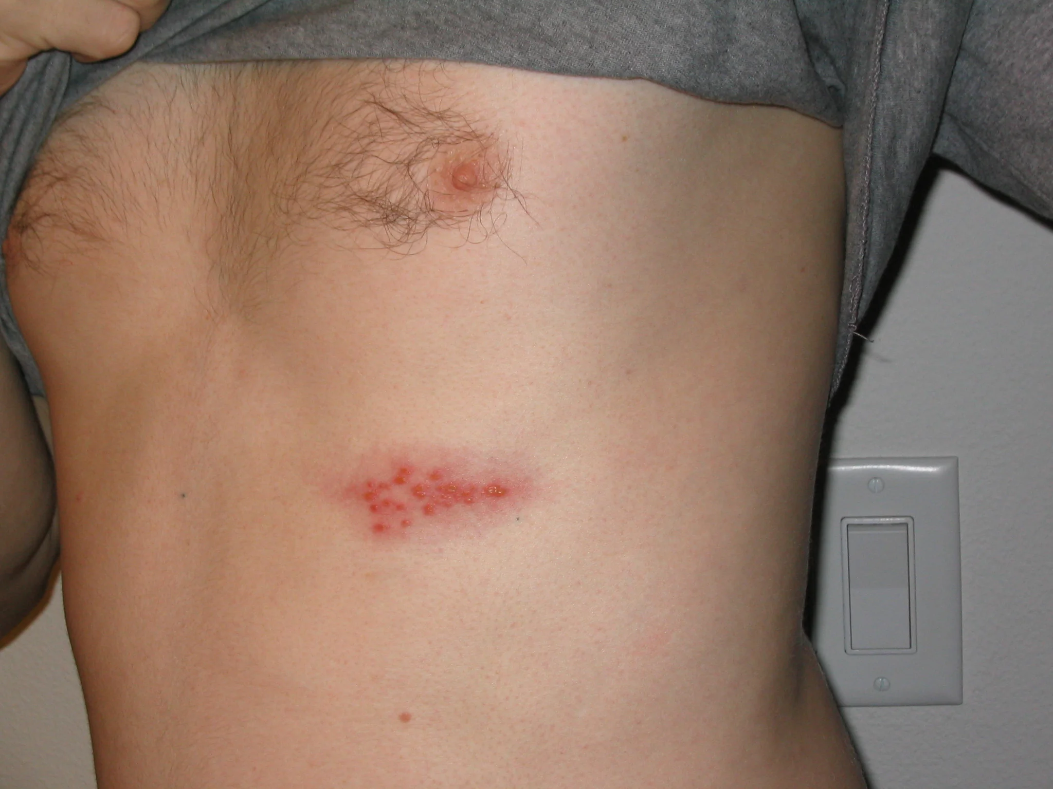 Fotografia clínica de lesões de herpes-zóster no tórax, com agrupamentos de pequenas bolhas e vermelhidão.