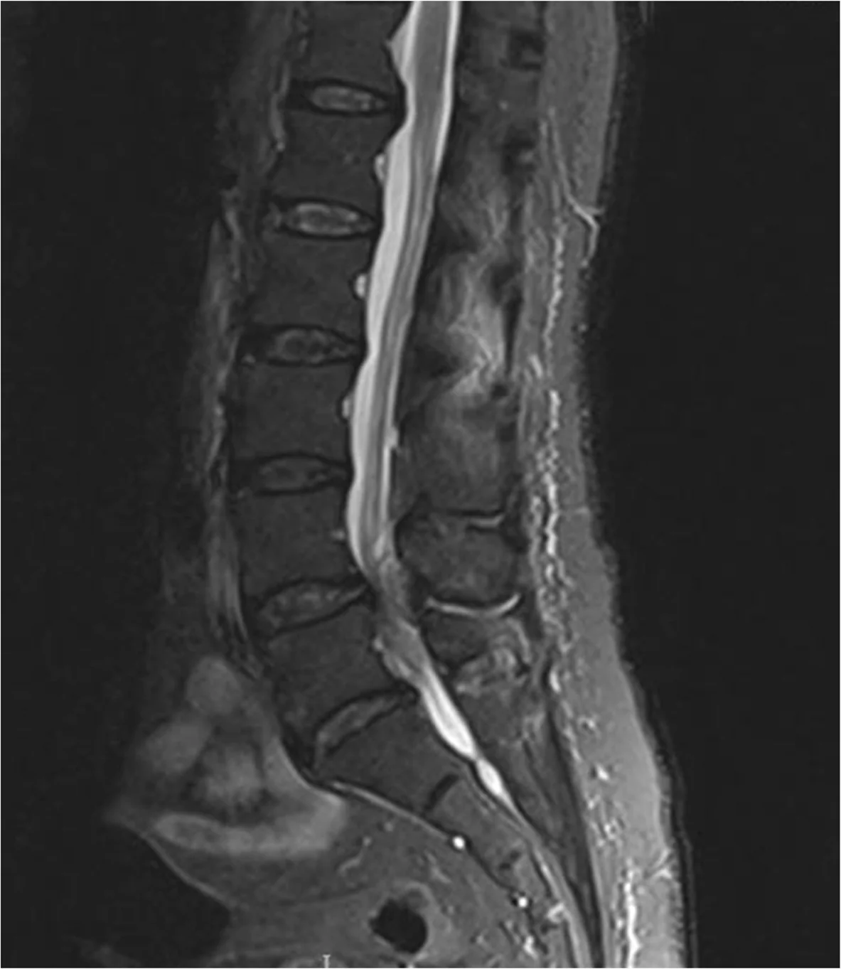 Ressonância sagital lombar com abscesso epidural posterior e compressão da cauda equina, em caso publicado.